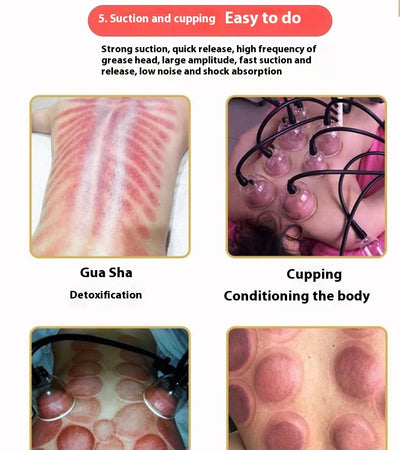 Electric cupping therapy device in use with multiple suction cups applied on back for body conditioning and detoxification